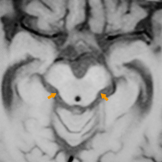 図1 頭部MRI所見