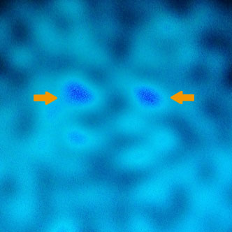 図2 進行性核上性麻痺の大脳基底核機能検査