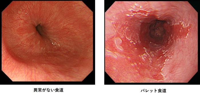 食道写真