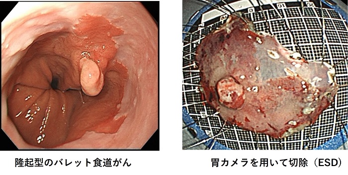 発赤調の食道癌