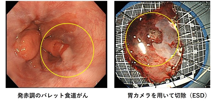 発赤調の食道癌