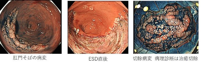 直腸の早期大腸がん