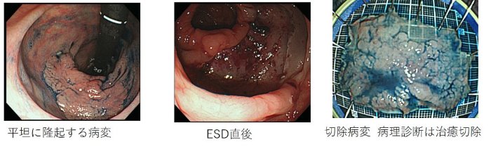 横行結腸の早期大腸がん