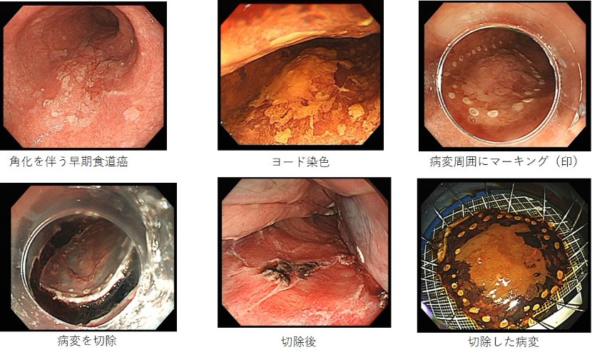 角化を伴う早期食道癌