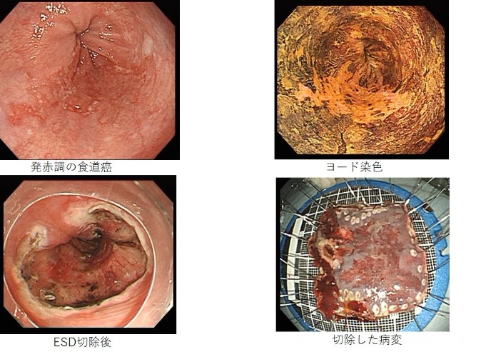 発赤調の食道癌