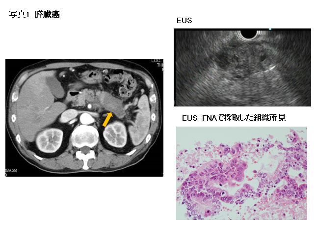 写真1　膵臓癌