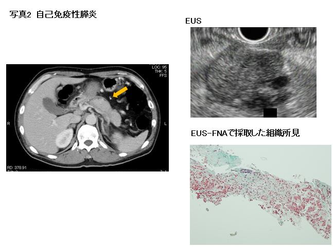 写真2　自己免疫性膵炎