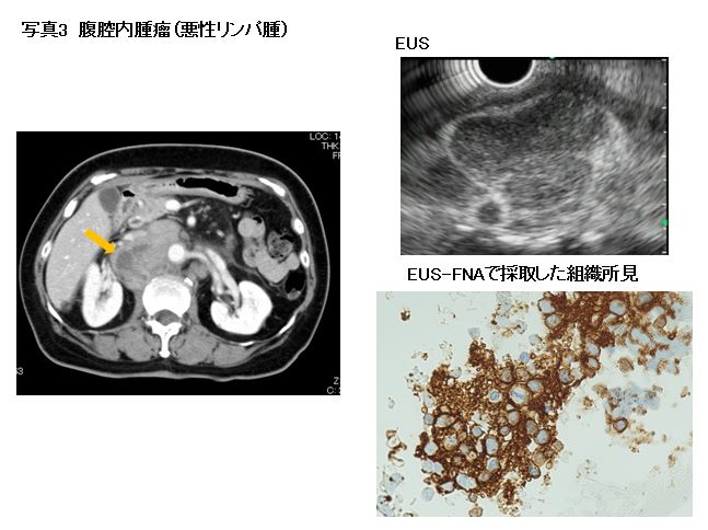 写真3　腹腔内悪性リンパ腫