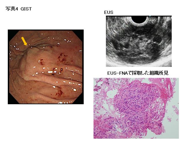 写真4　胃　GIST