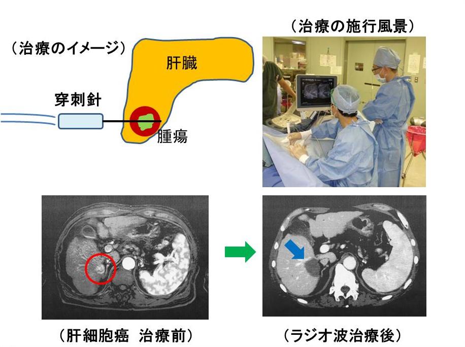 ラジオ波治療