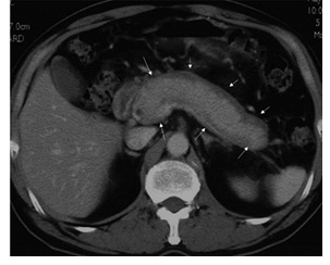 自己免疫性膵炎