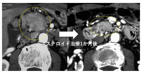 膵頭部腫大の自己免疫性膵炎